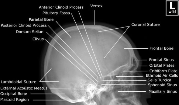 Radiographic Anatomy - Skull Lateral | Medical radiography, Medical ...