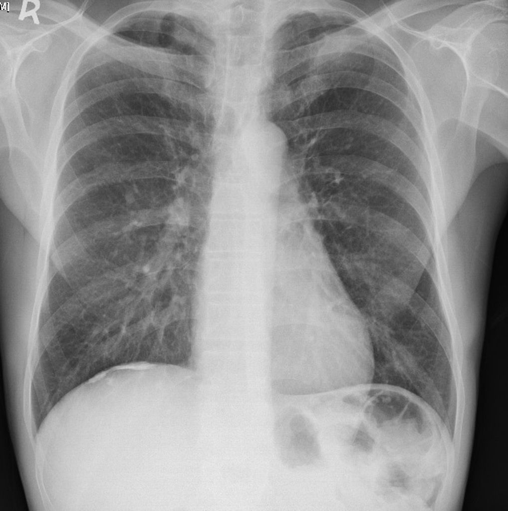 Thoracic Aortic Aneurysm Radiopaedia