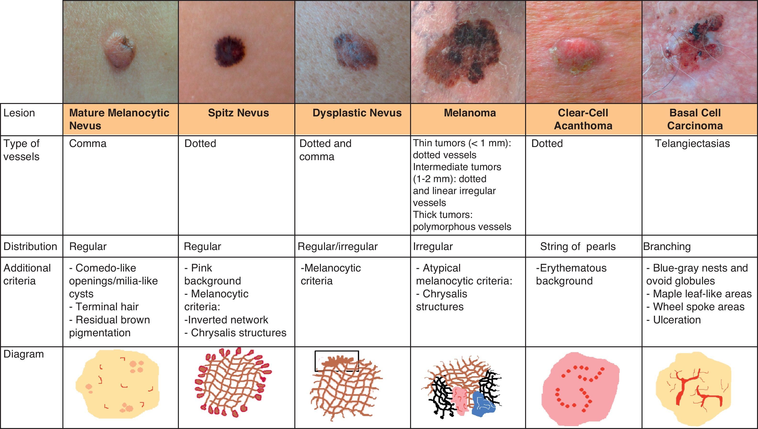 Basal Cell Carcinoma Types