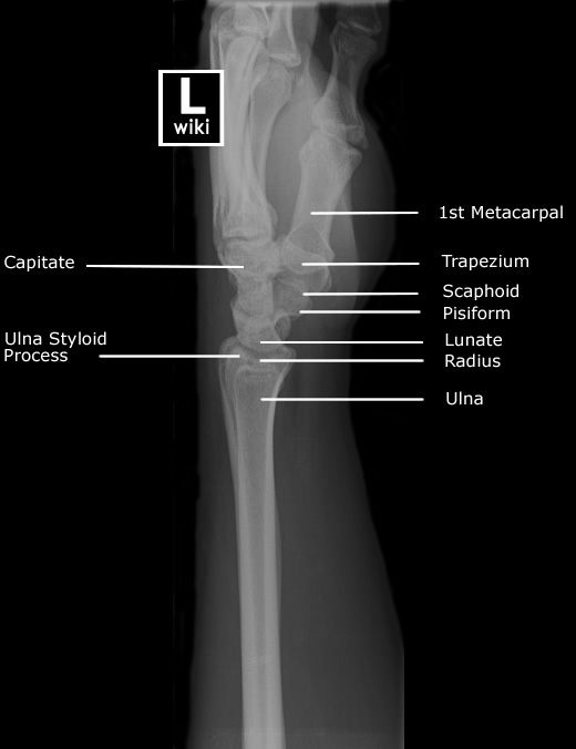 Wrist Radiographic Anatomy | Radiology student, Radiology, Radiology ...