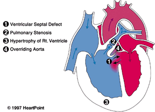 Addison has this Congenital Heart Defect: Tetralogy of Fallot Chd ...