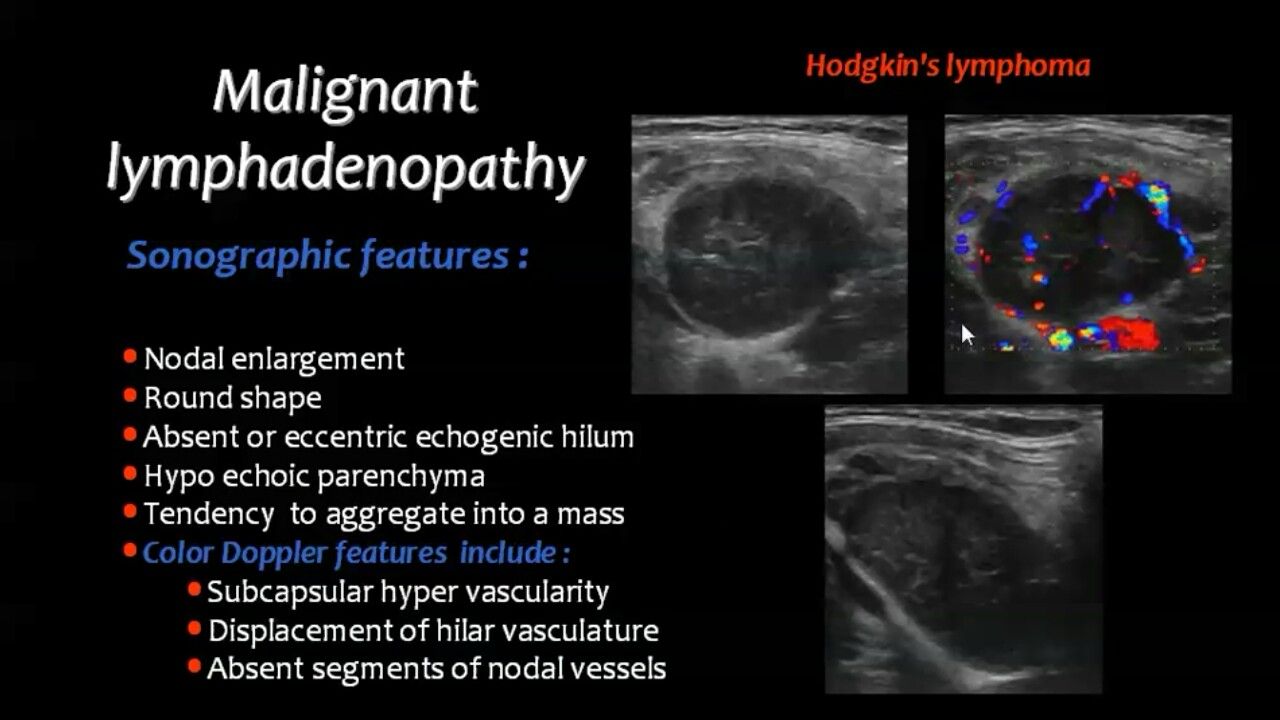 lymphoma thyroid cancer ultrasound colors - Zachery Burnette