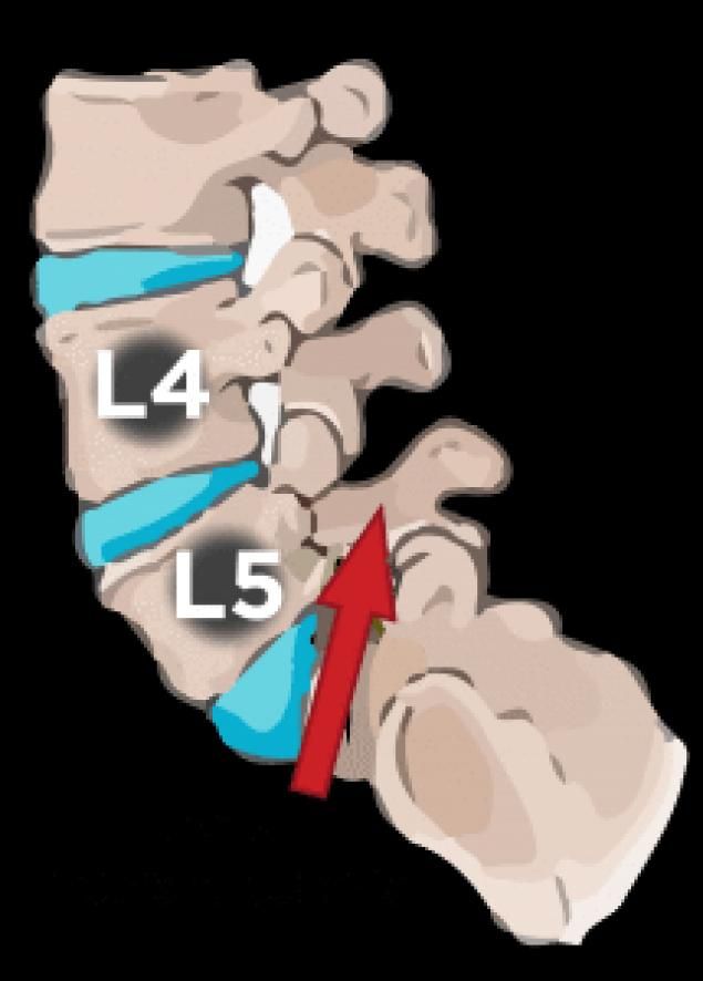 Have A Pars Defect at L4-L5? It Might Be Spondylolisthesis # ...