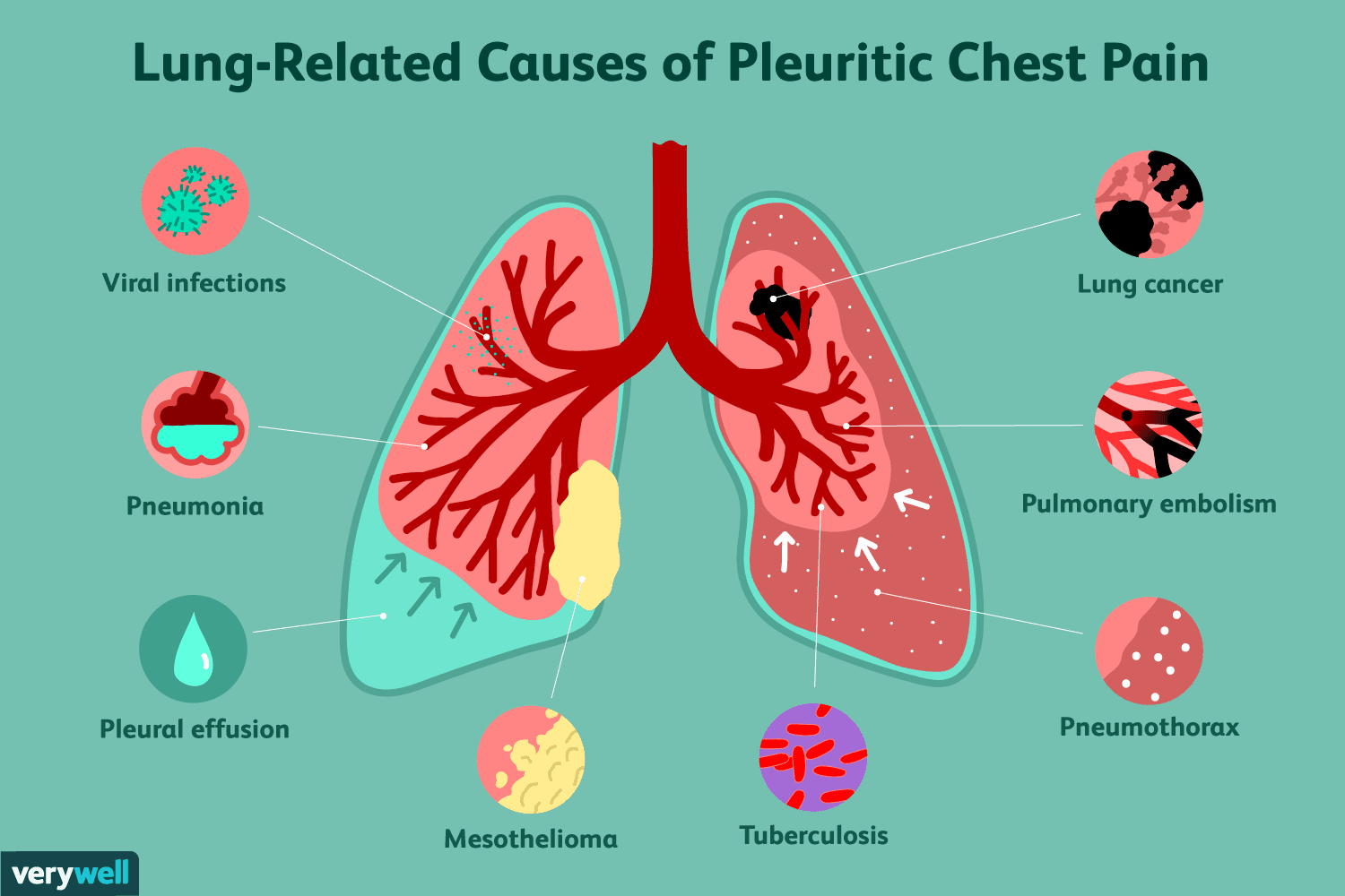 Chest Pain And Bad Cough at Tara Burke blog