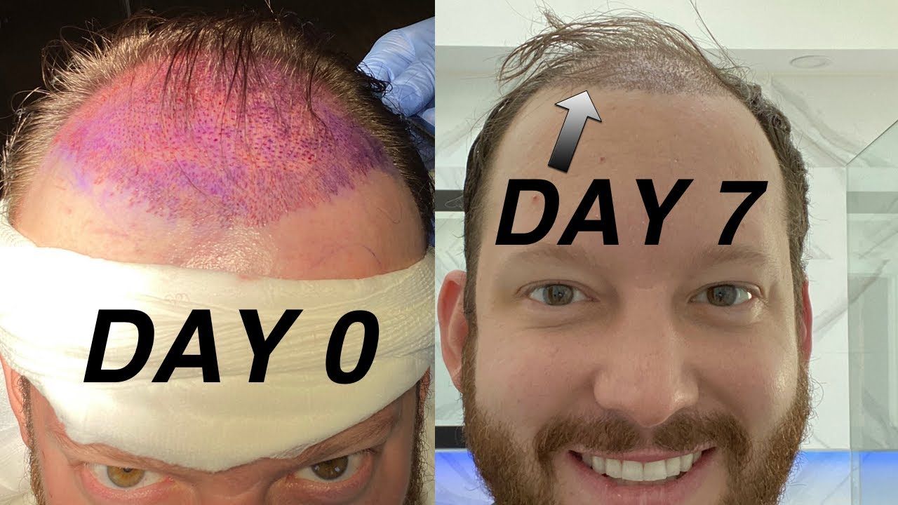 Hair Transplant Recovery at Thomas Ybarra blog