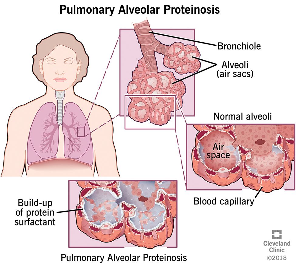 Pulmonary Alveolar Proteinosis (PAP) | Pulmonary, Asthma symptoms, Rare ...