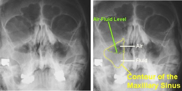 Imaging of Maxillary Sinusitis (Waters View, CT Scan, MRI ...