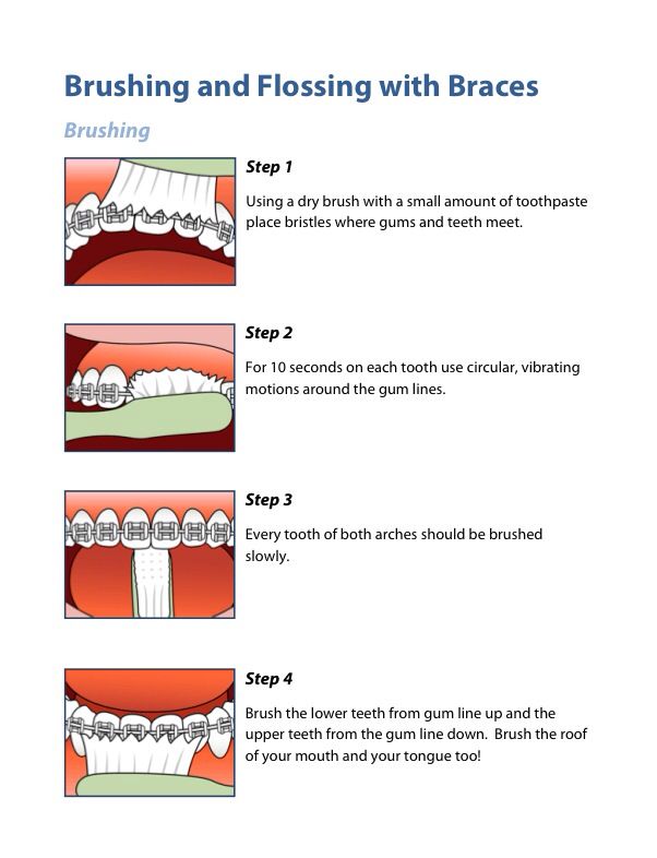 Pin by Kayla Brown on Braces tips in 2024 | Braces tips, Teeth care ...