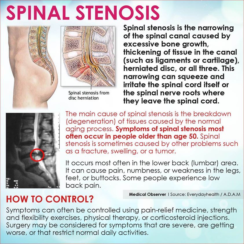 Here are some basic facts about spinal stenosis Cervical Spinal ...