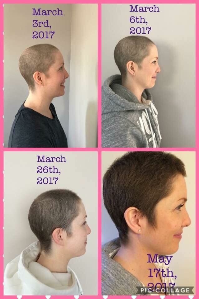 Hair regrowth after Chemo Hair regrowth