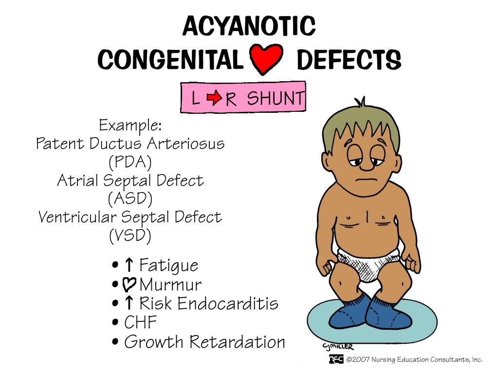 Acyanotic heart defect