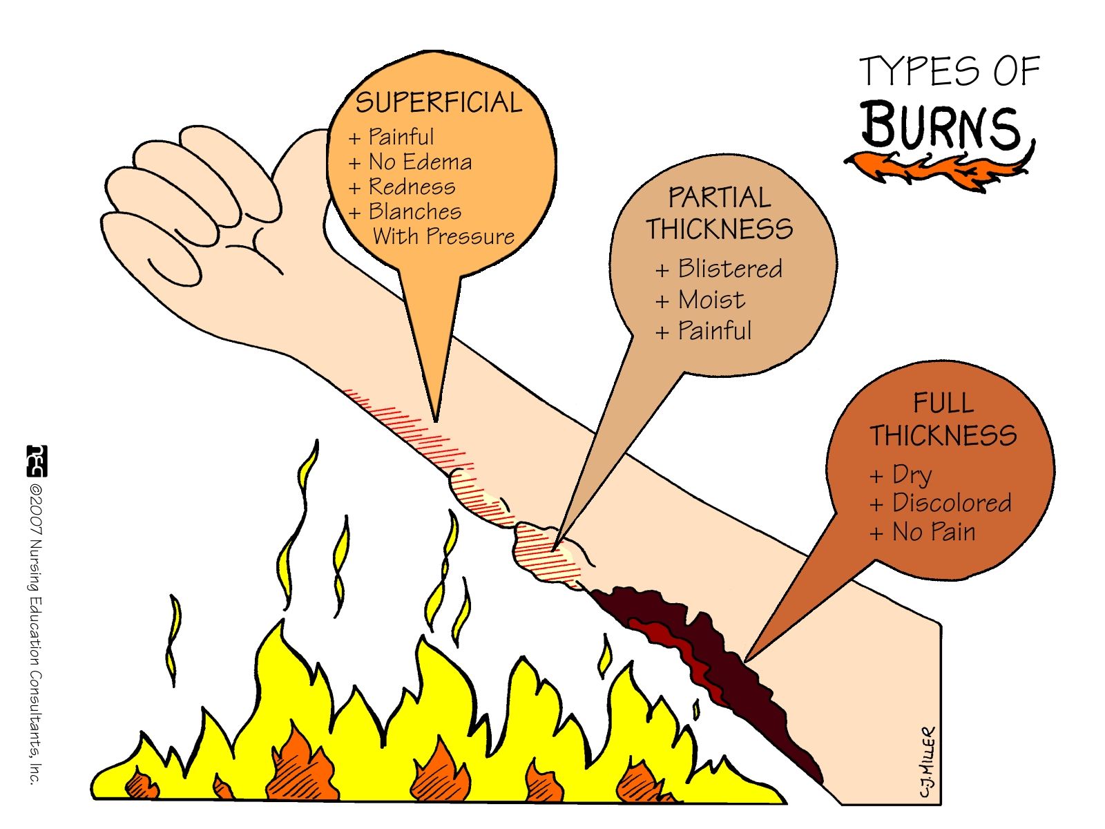 Types Of Burn Patterns