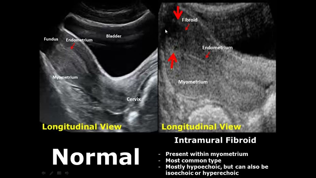 Intramural, Sonography, Cervix, Mri, Uterus, Ultrasound, Pathology ...