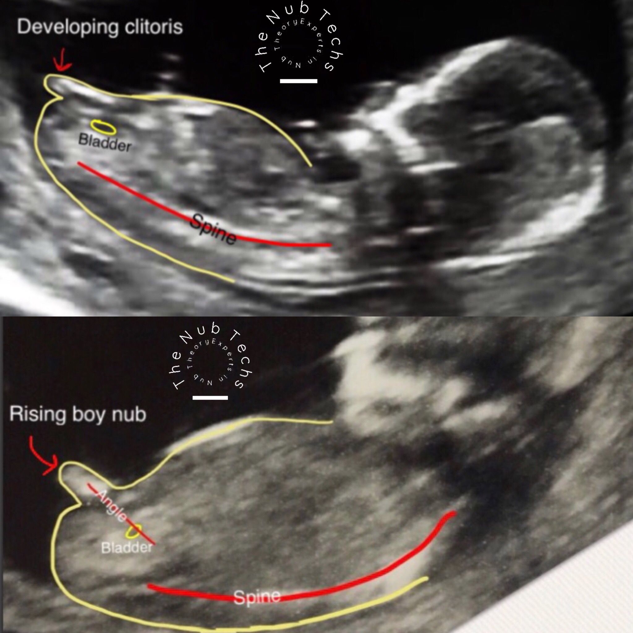 12 Week Ultrasound Gender, Boy Ultrasound Pictures, Ultrasound Gender ...