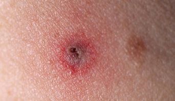 Pin on Lyme Disease Education