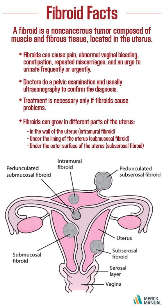 Intramural Fibroid Size Chart