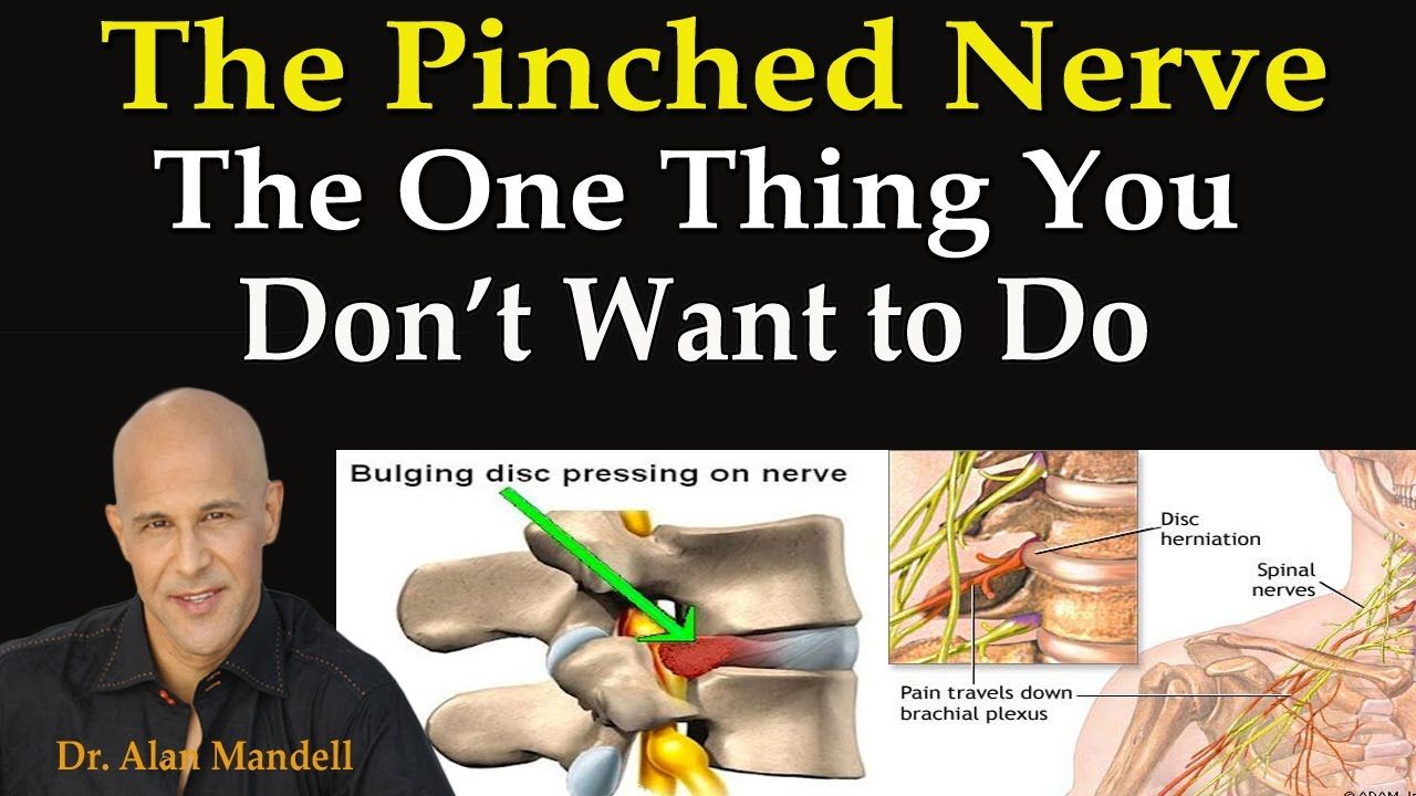 What Is Treatment For Pinched Nerve In Neck - vrogue.co