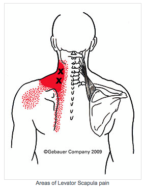 c6 trigger point nerve pain | Stiff Neck? Blame Levator Scapulae ...