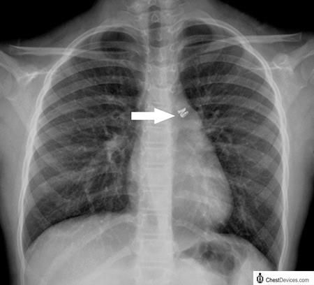 patent ductus arteriosus x ray - Google Search | Patent ductus ...