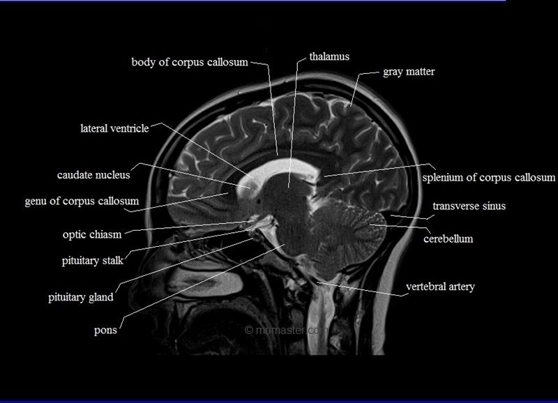 Cross Sectional Anatomy Mri Brain Sagittal Anatomy Free Mri Brain ...