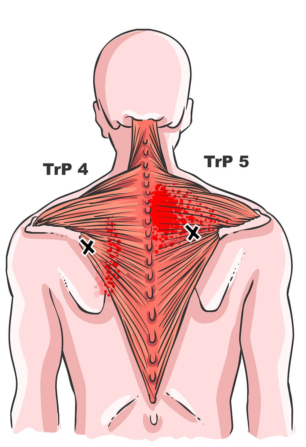 Trapezius of monnikskapspier: Pijn Reset Methode | Buikspieren, Pijn ...