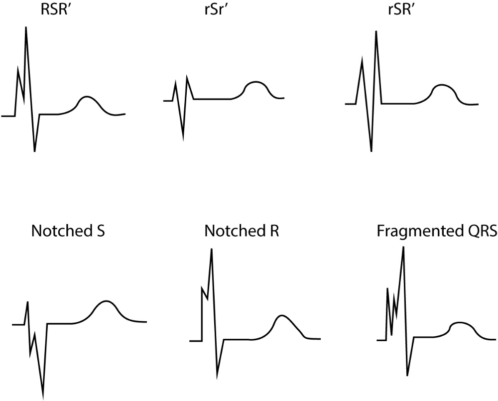 Stemi Vs Nstemi, Cath Lab Nursing, Bundle Branch Block, Medical ...