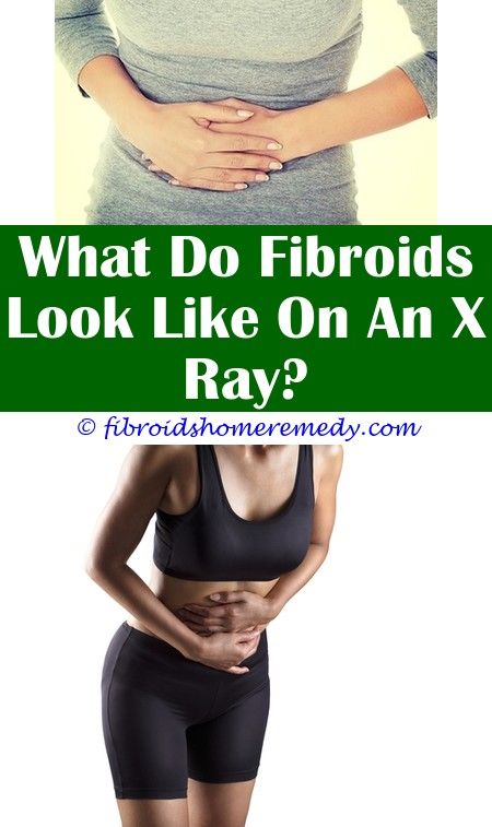 Uterine Fibroids Pictures Images (With images) | Uterine fibroids ...