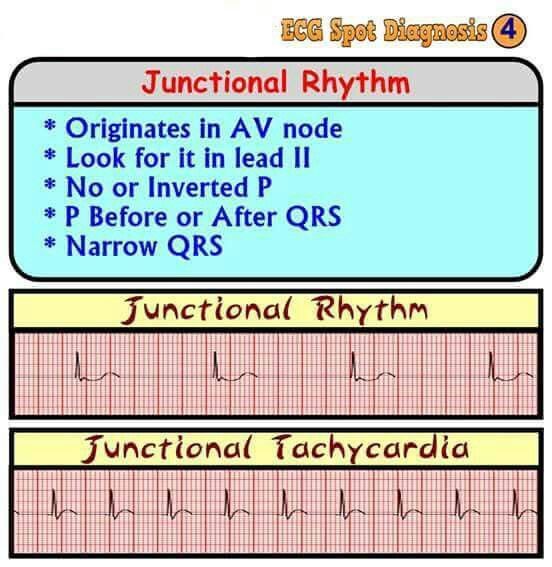 Junctional Tachycardia