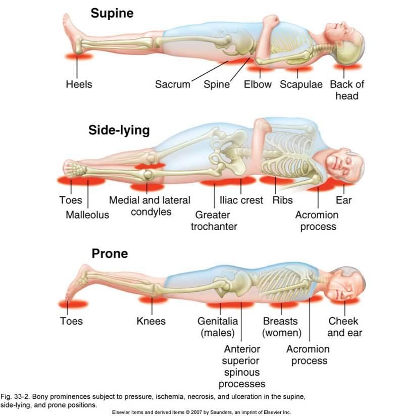 sleeping on stomach pressure points - Google Search Pressure Ulcer ...