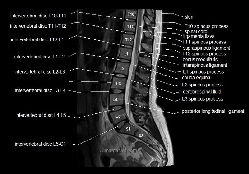 Mri Lumbar Spine Labeled image.