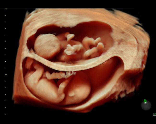 Pin by Linda Rodriguez on Random | 3d ultrasound, Ultrasound reveal ...