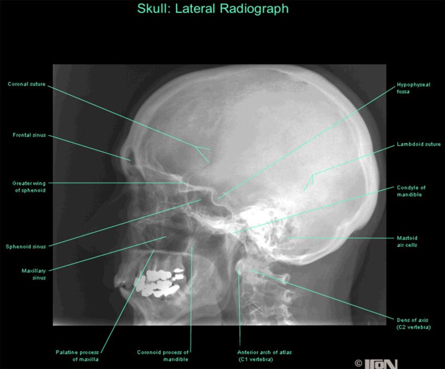 Lateral radiograph skull | Skull anatomy, Anatomy, Anatomy images