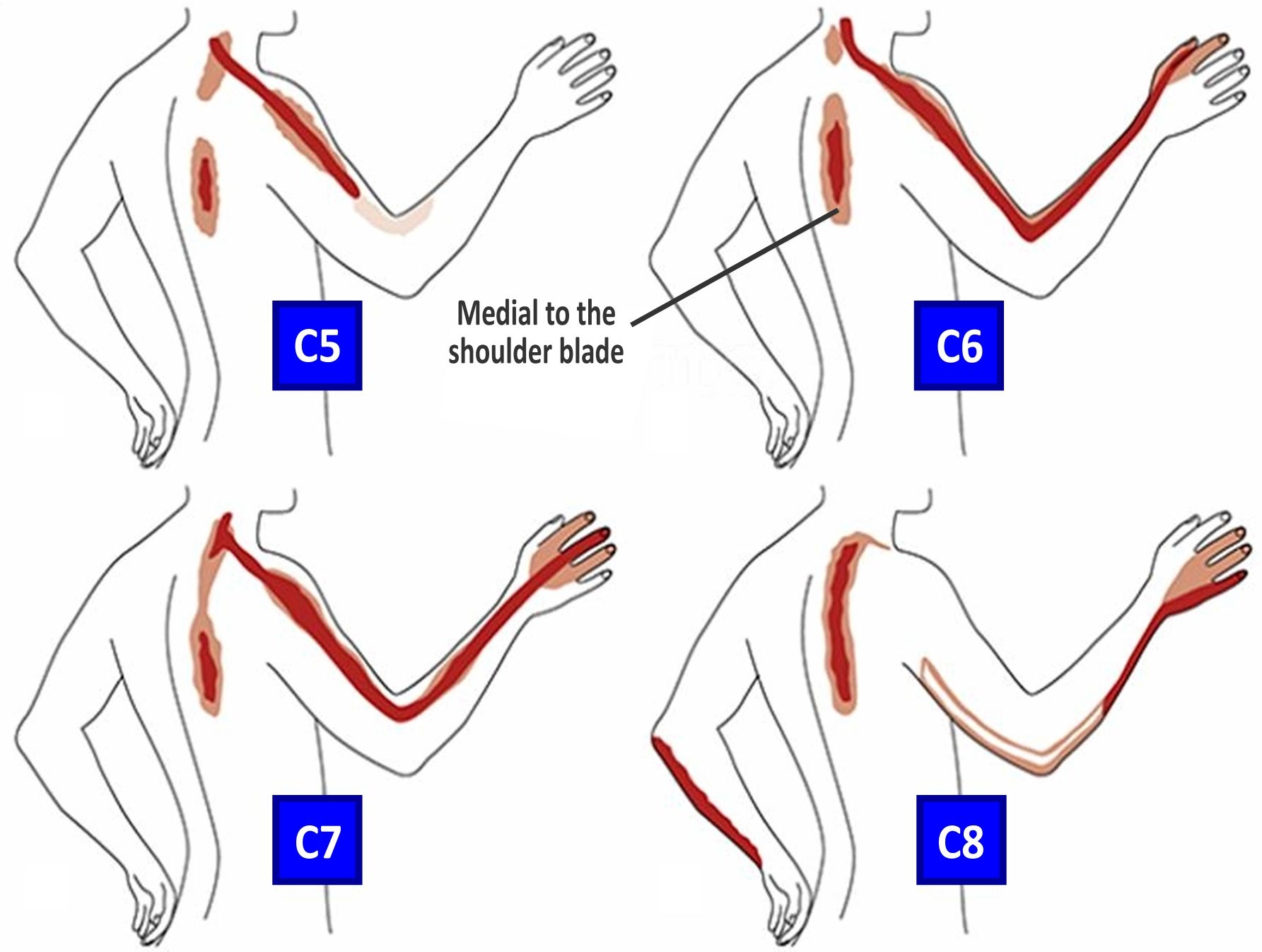 Cervical Radiculopathy Causes Symptoms And Treatment - vrogue.co