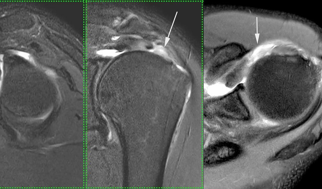 Pic Of the Day - Supraspinatus & Subscapularis Tears Subscapularis tear ...