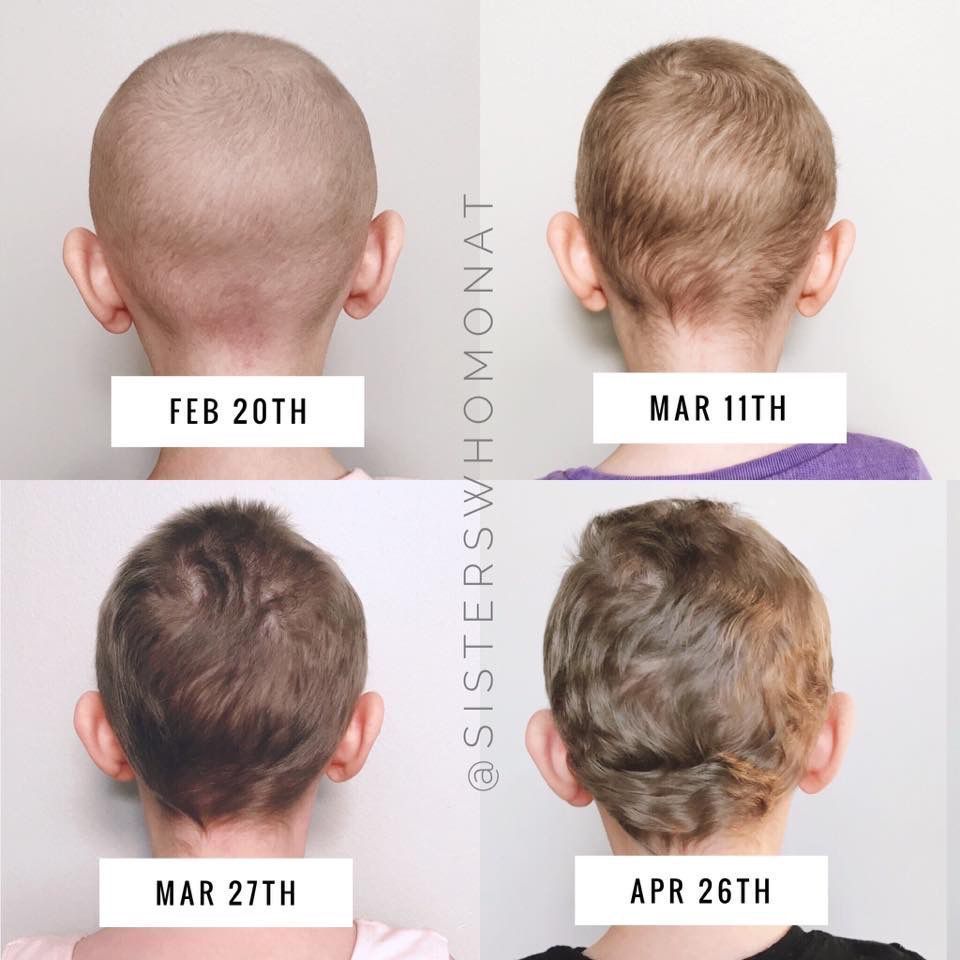 Before and after chemo hair growth Insane hair growth transformation