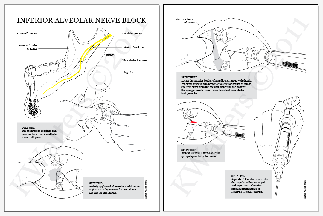 Inferior Alveolar Nerve Block Anatomical Landmarks