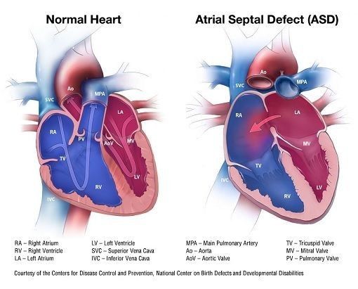 Understanding Atrial Septal Defect in Pediatric Cardiac Nursing