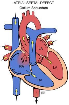 aSD left to right shunt - Google Search | Interventional radiology ...