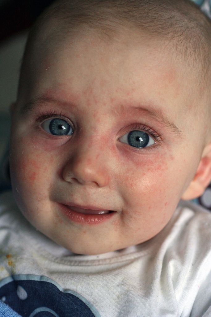 The Most Common Food Allergies The face of baby food allergies. Awhhhh ...