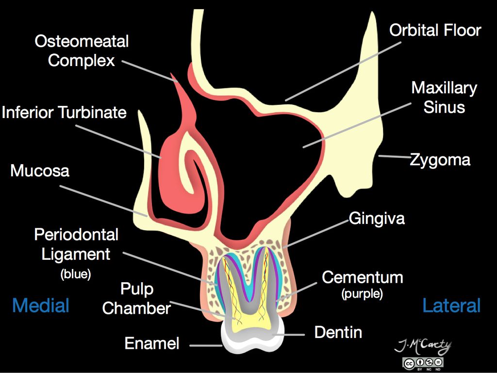 Maxillary sinus - illustration | Radiology Case | Radiopaedia.org ...