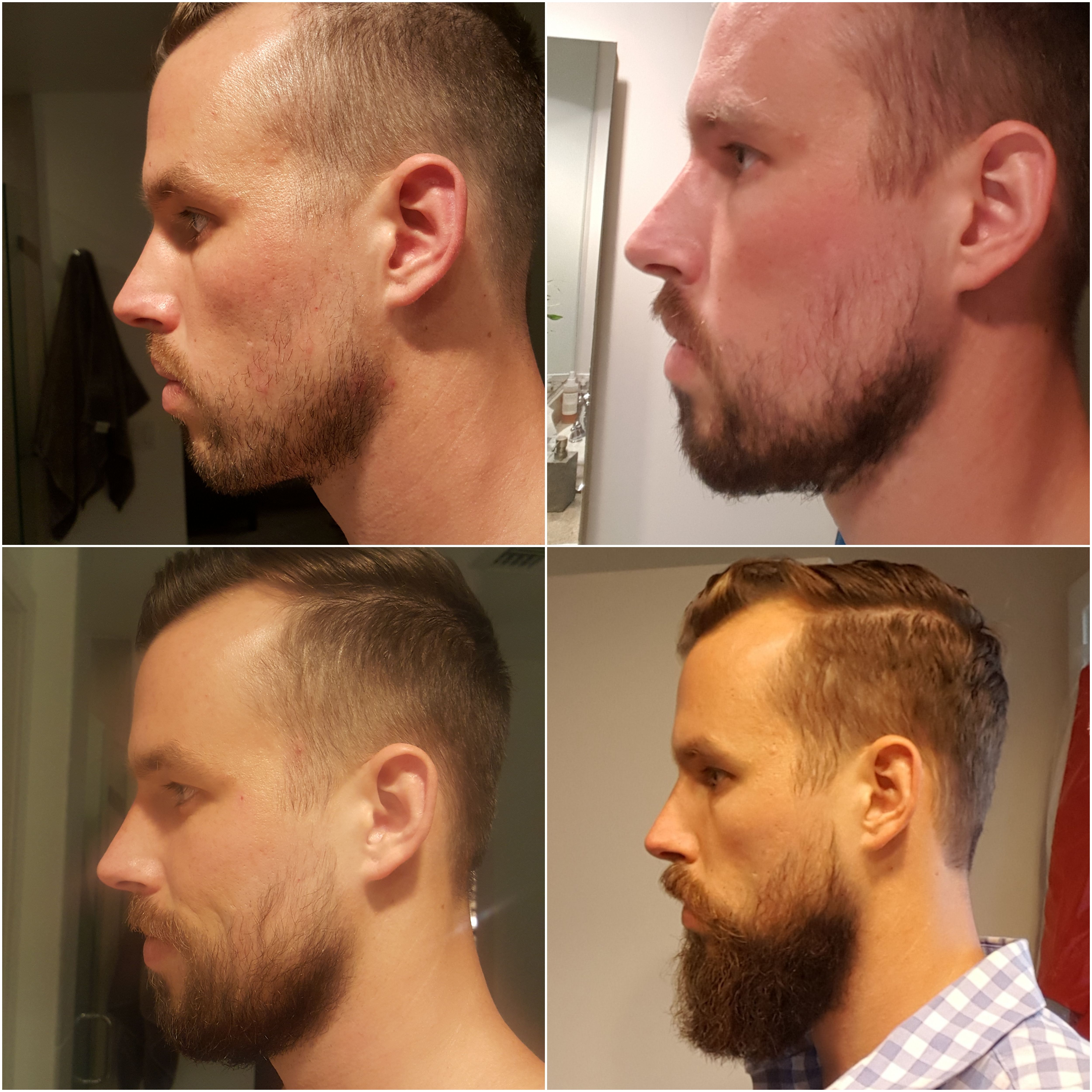 Patchy Beards Before And After | Beard on Brother