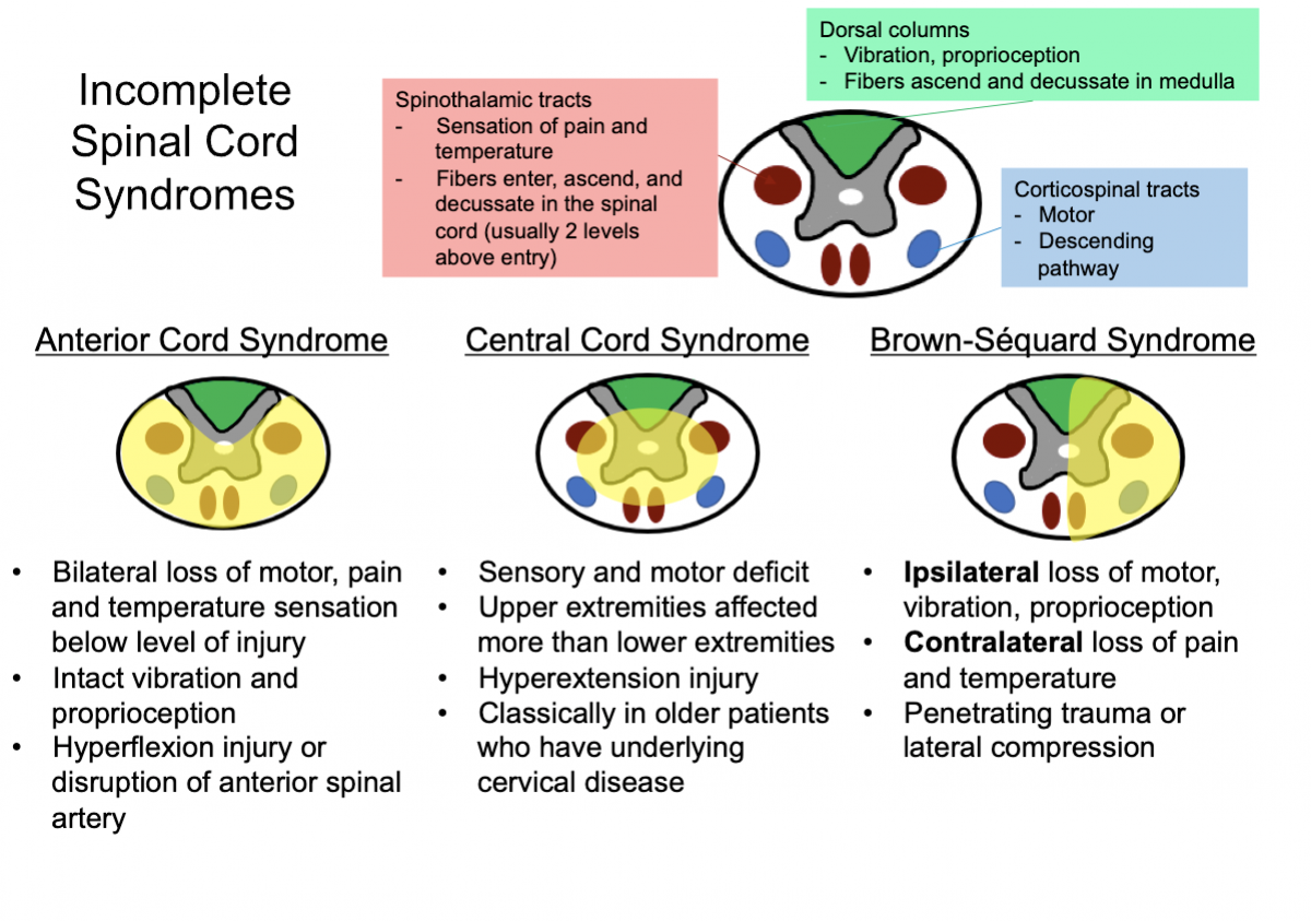 Incomplete Spinal Cord Syndromes Anterior Cord Syndrome: ... | Spinal ...