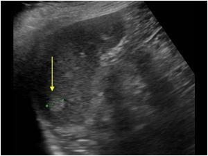 Splenic Hemangioma Ultrasound