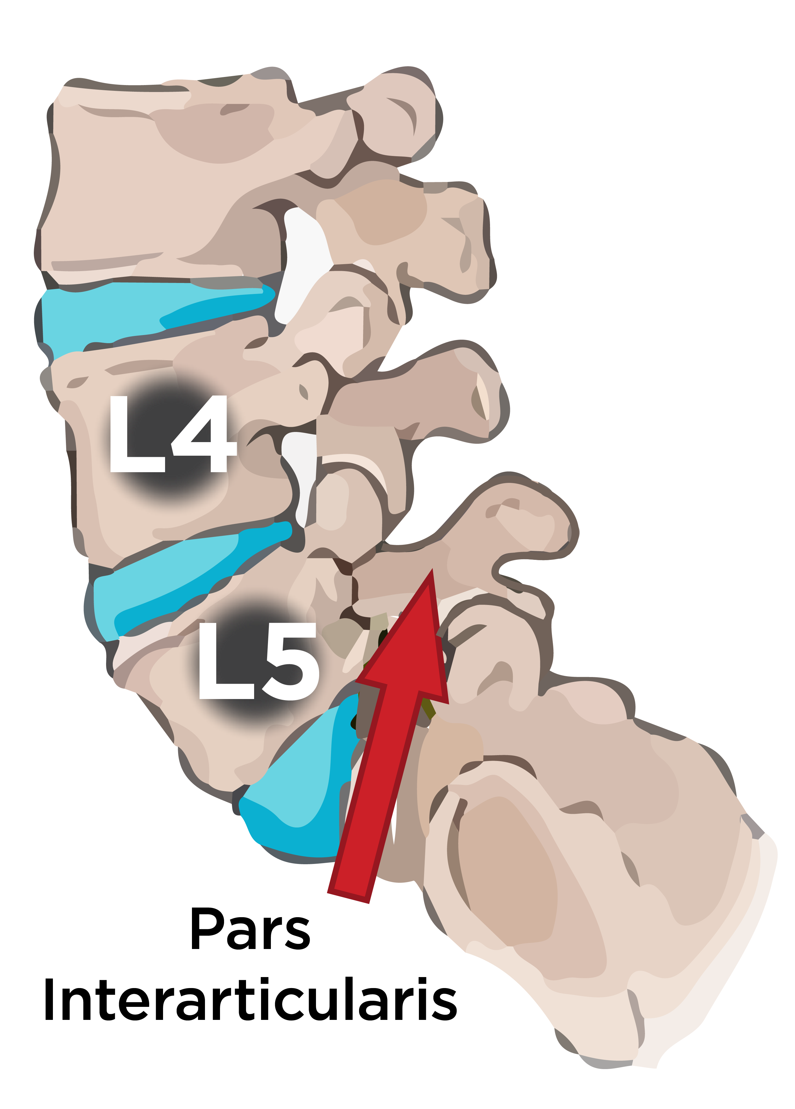 What Is Pars Defect - mapageprek image.