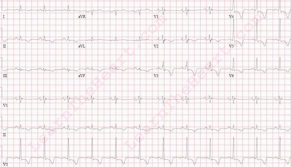 Arrhythmogenic right ventricular dysplasia ECG - Note the Epsilon wave ...