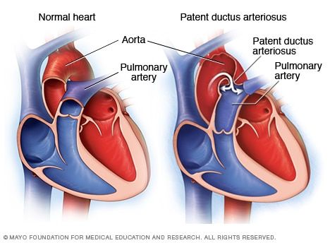 Image result for ductus arteriosus | Ductus arteriosus, Patent ductus ...