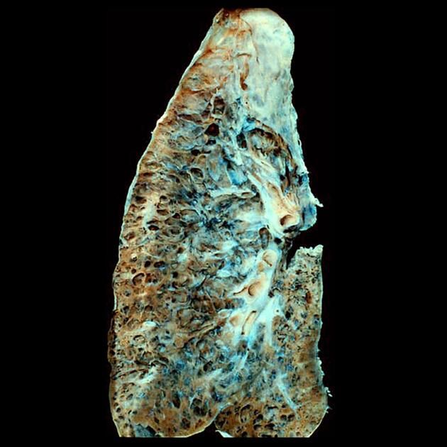 Honeycomb lung gross pathology radiology case radiopaedia org – Artofit