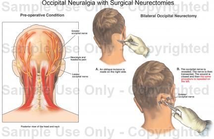 Occipital Neuralgia... Cervical Neuralgia, Occipital Neuralgia ...