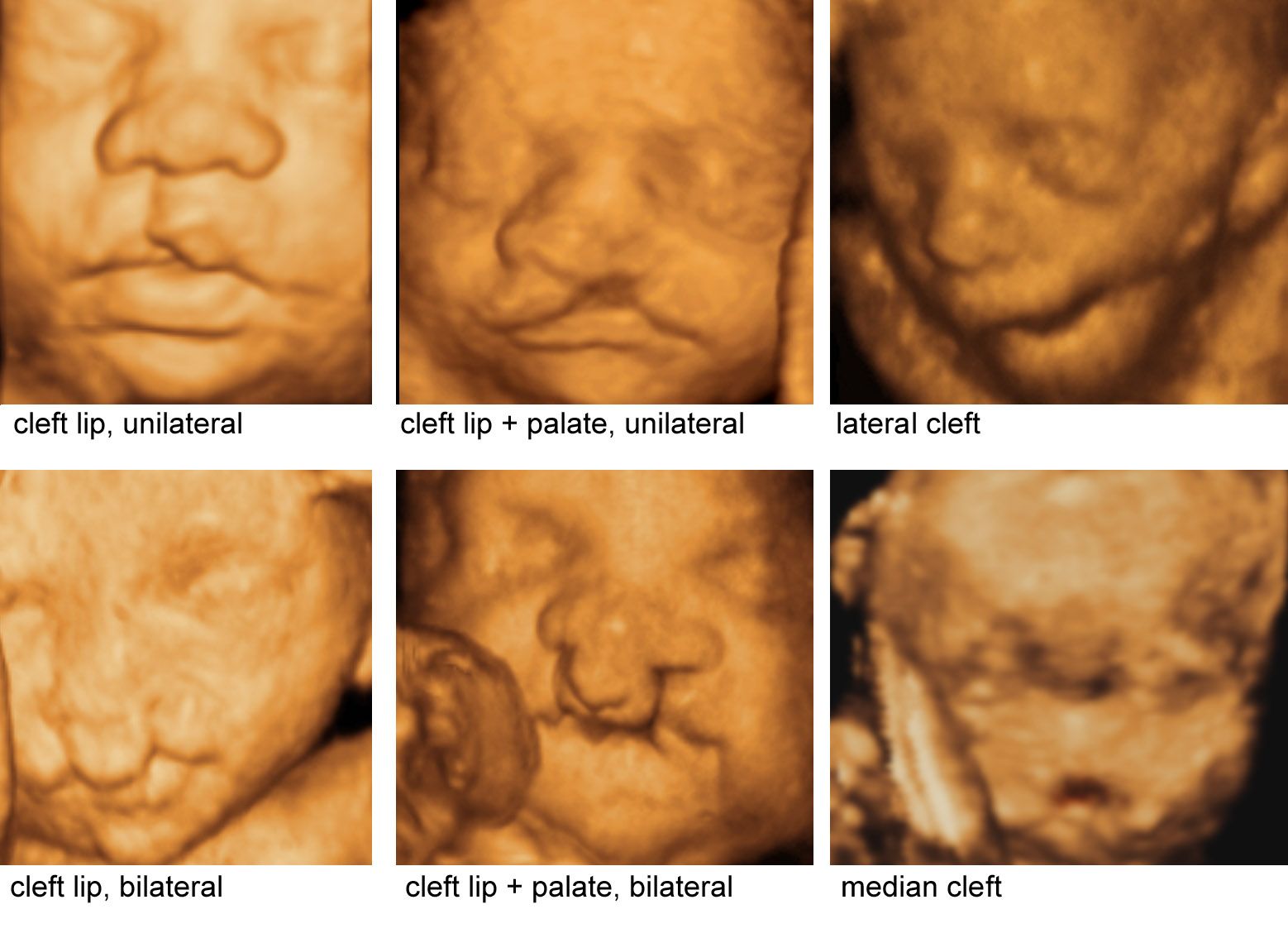 Pinterest | Obstetric ultrasound, Cleft lip, Ultrasound