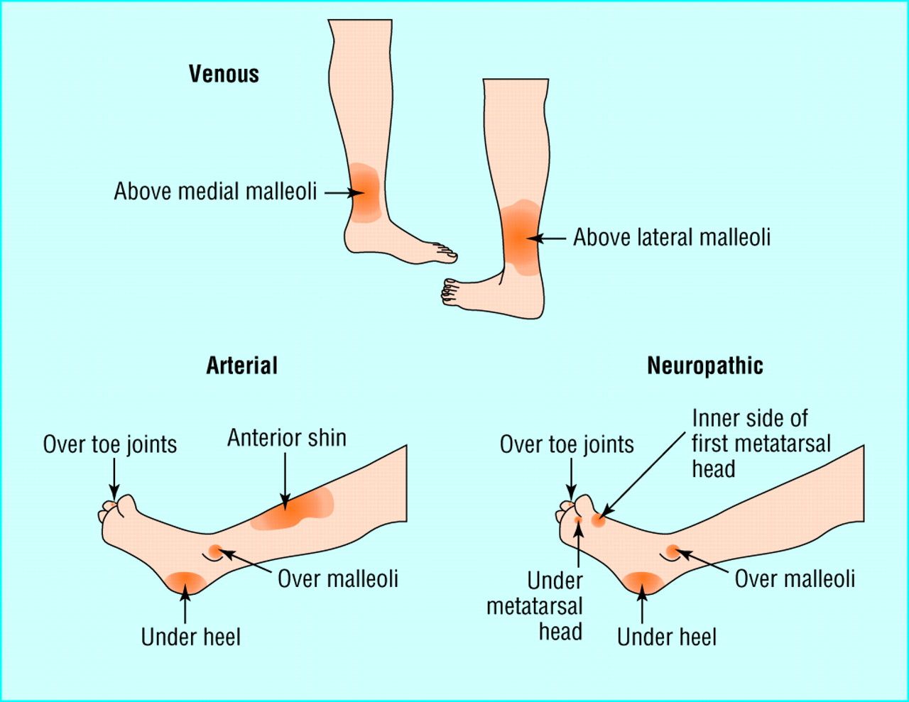 Types and typical sites of leg ulcer | Wound care nursing, Wounds ...